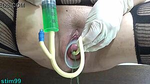 Extreme Cervix Prolapse with Bottles Hanging from Uterus